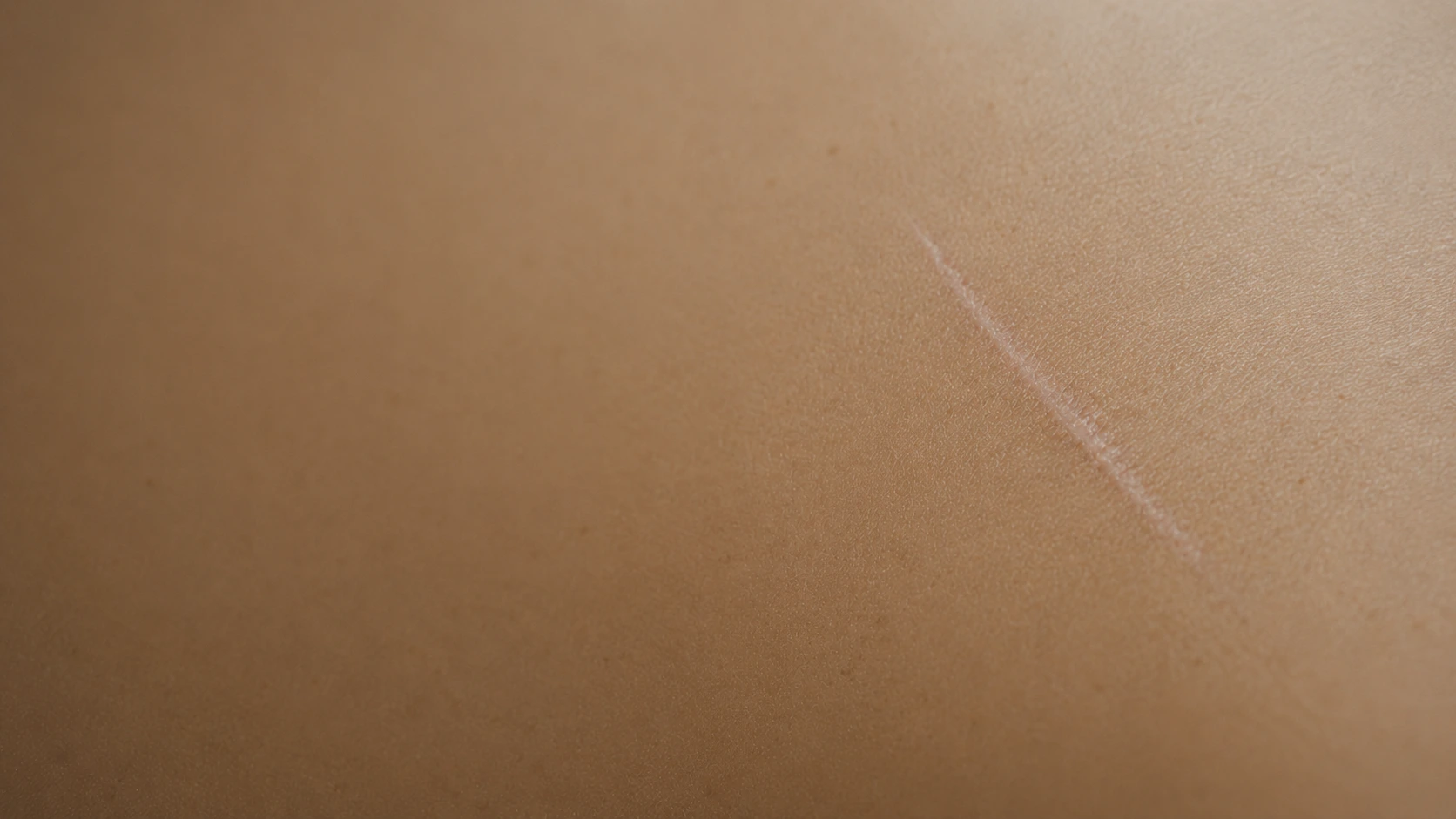 Dolor postquirúrgico persistente